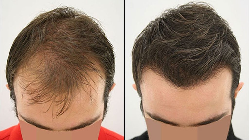 coraspin hairtransplantation