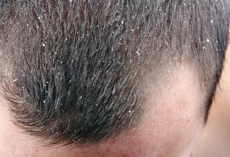 Dandruff hair