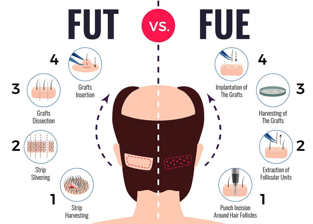 Fue vs Fut