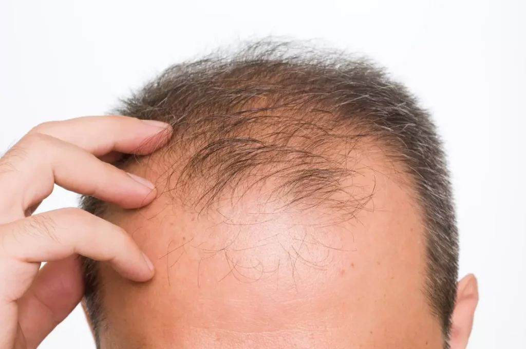 hair transplant 1