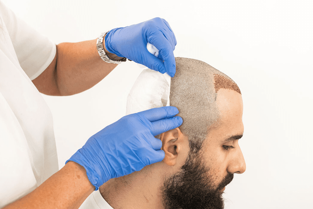 hair transplant 1