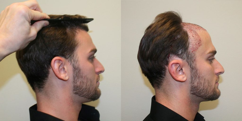 hair transplant 3