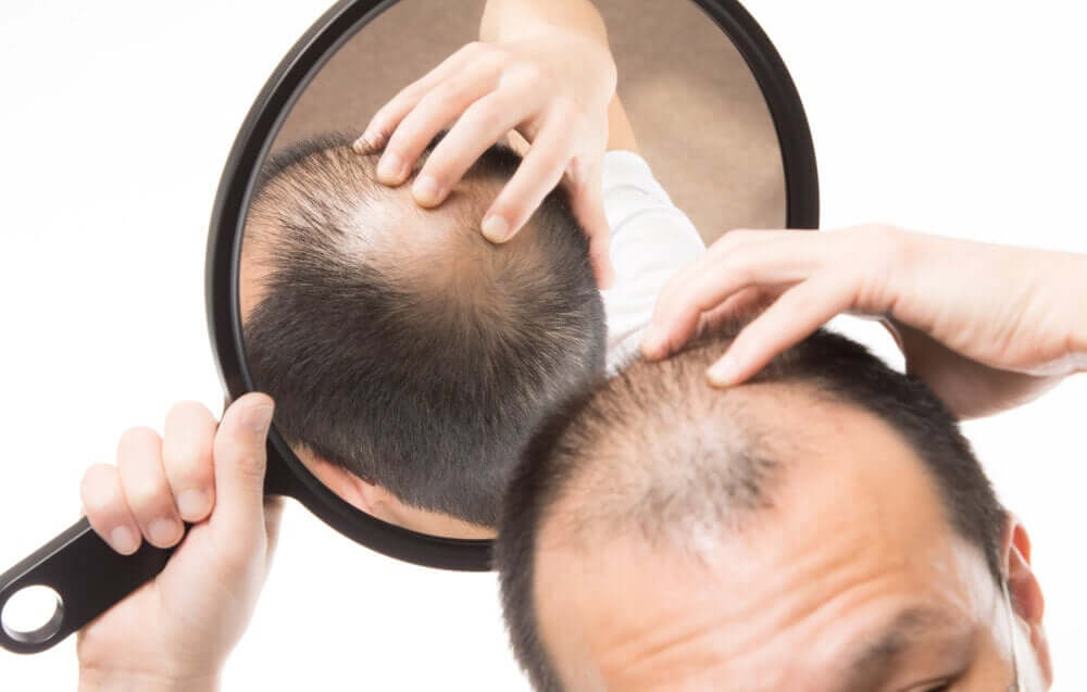 When Should you Consider Hair Transplant?