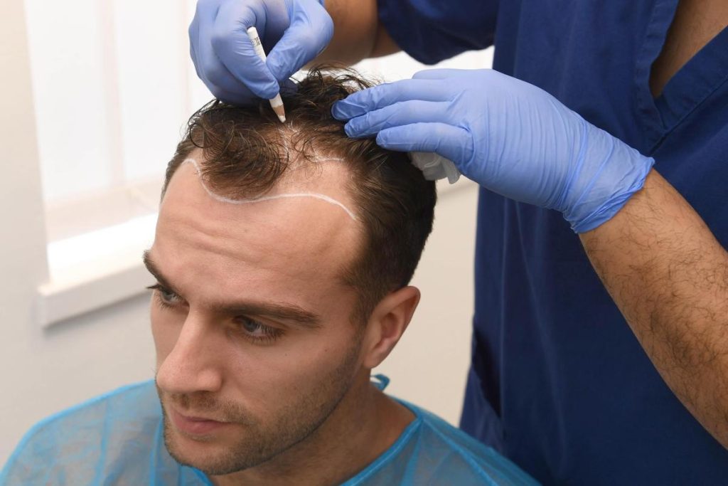 hair transplantation 1