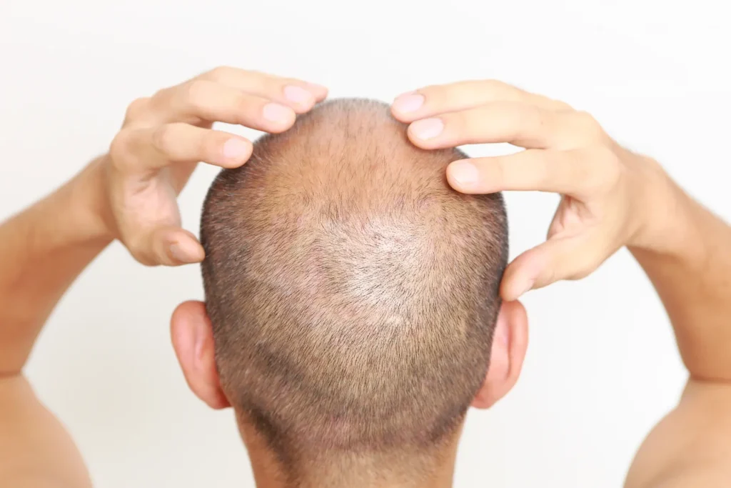 Hair Transplantation