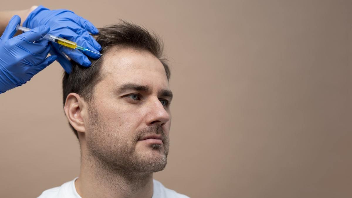 PRP Treatment After Hair Transplant