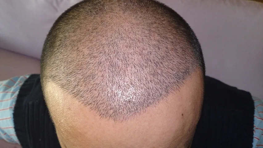 When Can I Fly After My Hair Transplant?