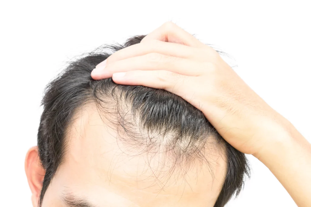 Wash After Hair Transplant