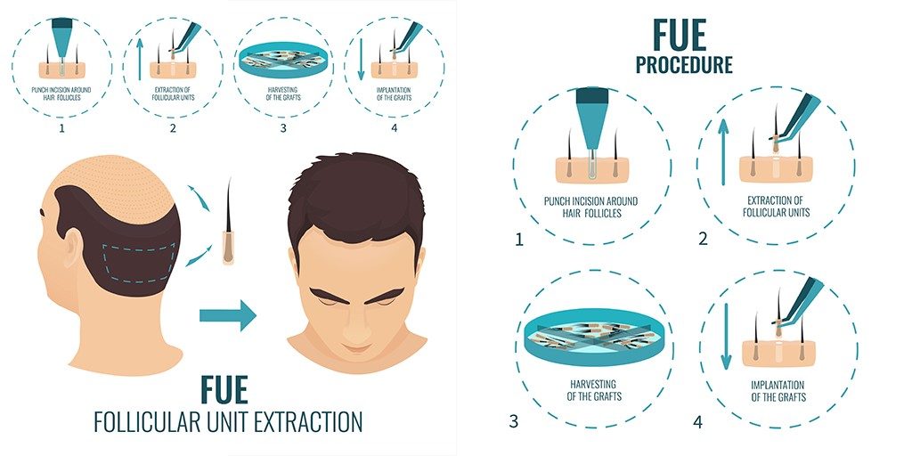 How to Know If FUE Hair Transplant Is Right for You
