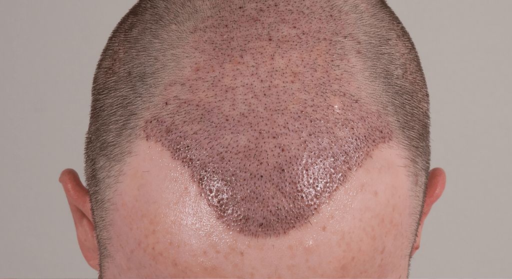 hair transplant 10 day 1