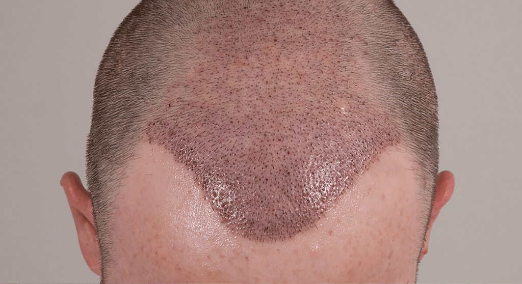 Post-Op: FUE Hair Transplant After 10 Days