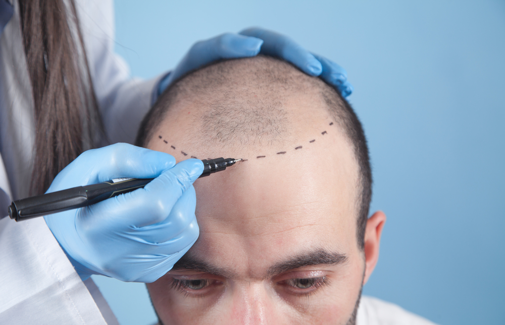 Who Invented the FUE Hair Transplant?