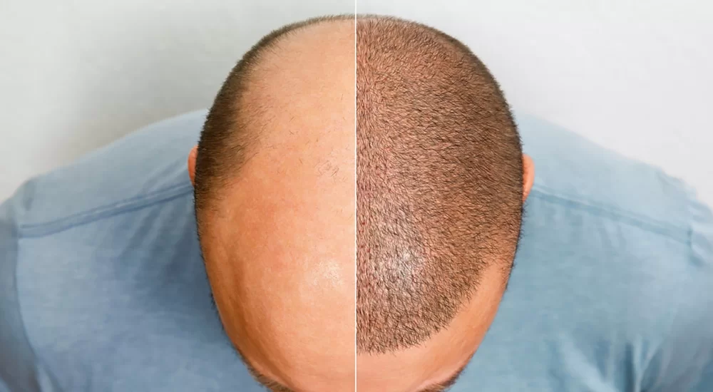 hair transplants