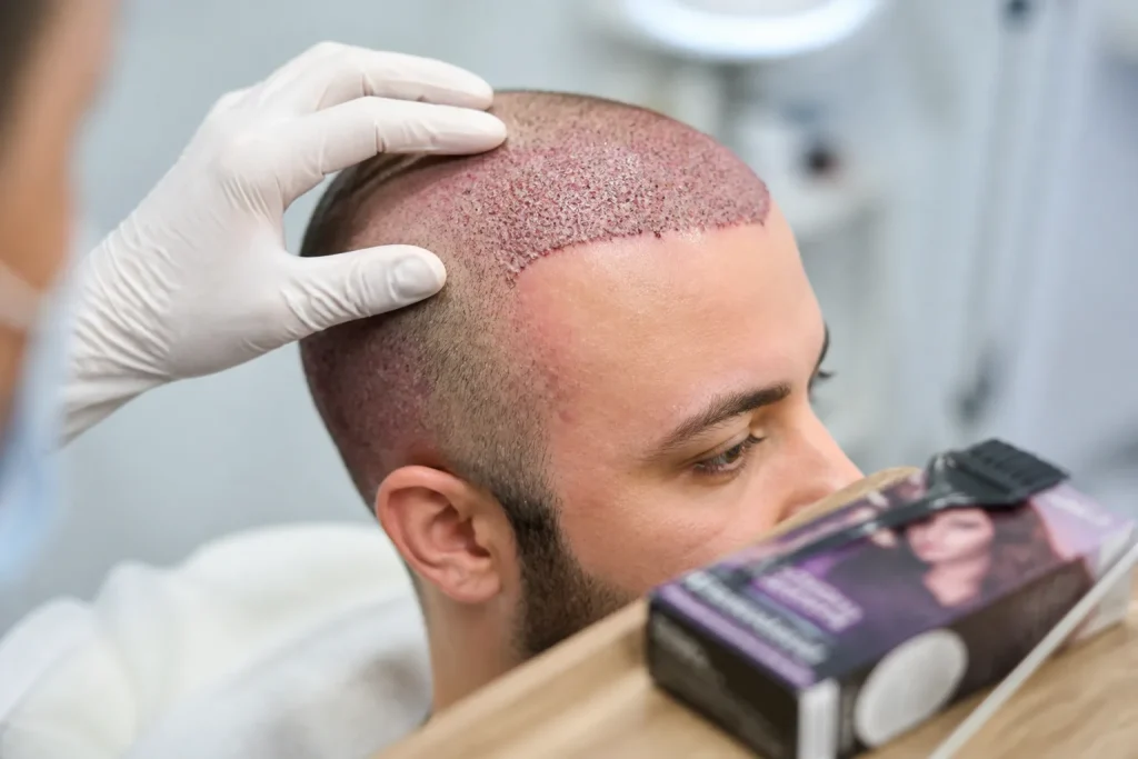 is it possible to dye your hair after a hair transplant surgery 20260915 214230 002