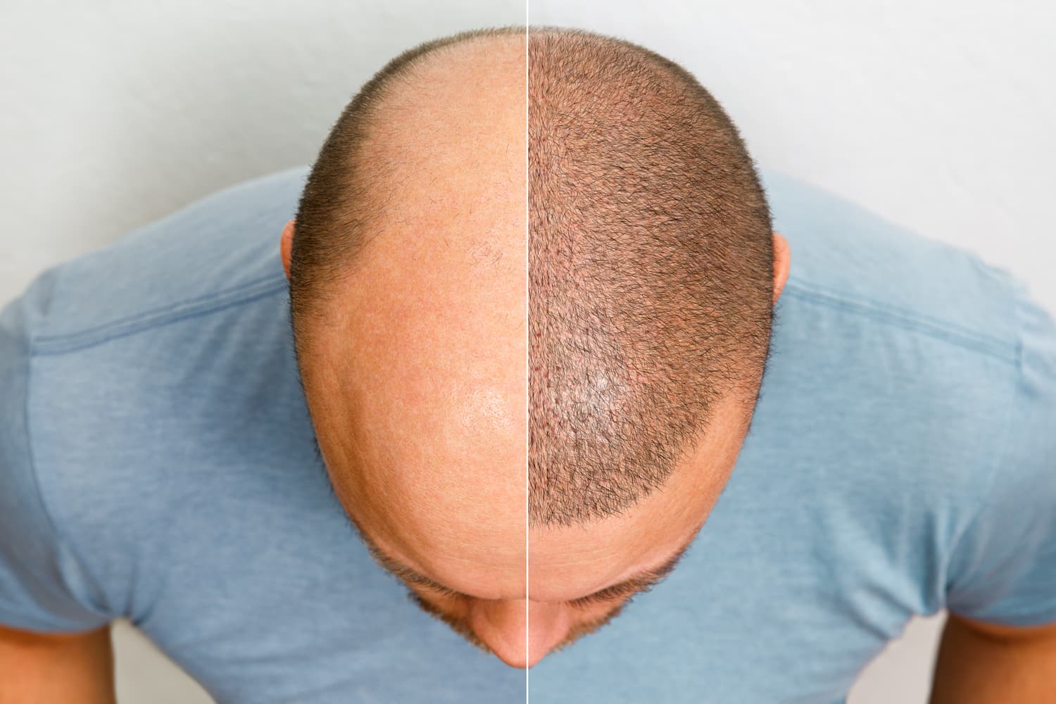 Chest to Scalp Hair Transplant