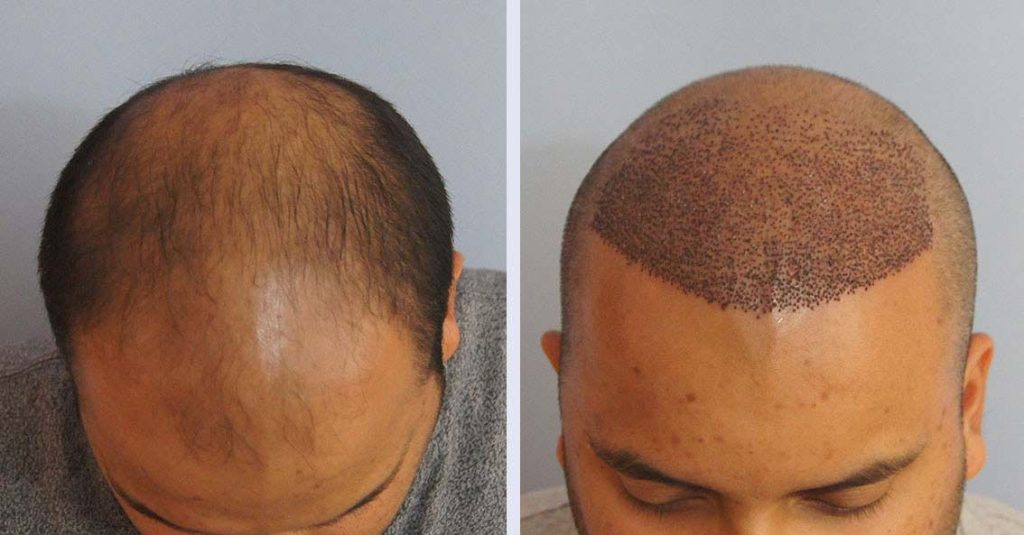 WHAT KIND OF DENSITY SHOULD I EXPECT AFTER A HAIR TRANSPLANT PROCEDURE?