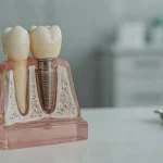 Can You Combine Dental Crowns With Dental Implants?