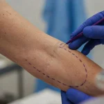 How Long Do Arm Lift Results Last?