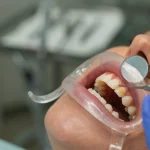 dental crowns pain – How Painful Is Dental Crowns? Patient Guide