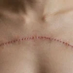 Incision Healing After Breast Reduction: What to Expect