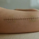 arm lift safety risks – Is Arm Lift Safe? Risks and Side Effects