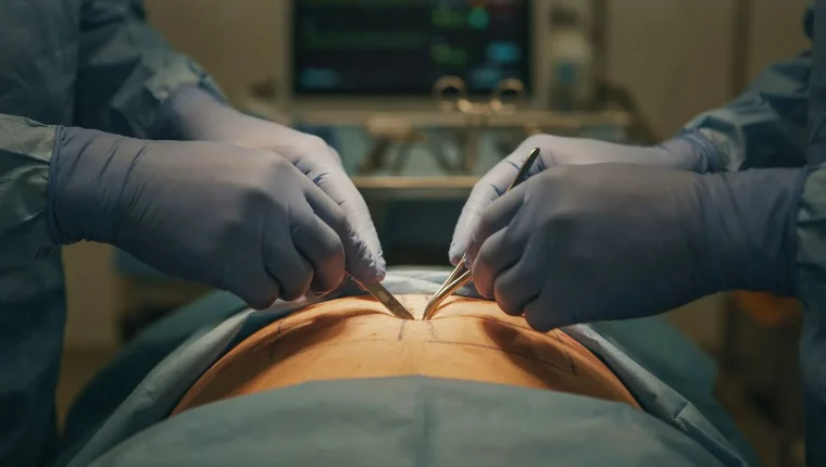 Is Body Lift in Turkey Worth It for Canadians?