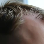 MPB Hair: Understanding Male Pattern Baldness